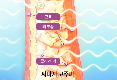 써마지