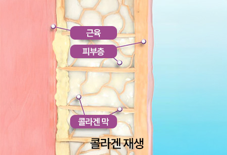 써마지