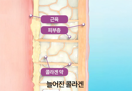 써마지