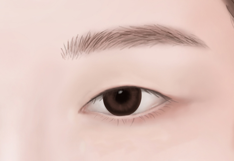 눈썹거상술