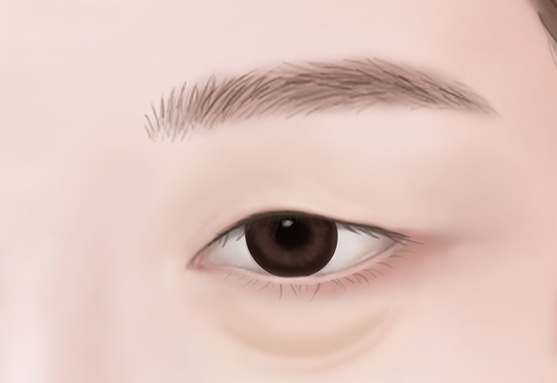 눈썹거상술
