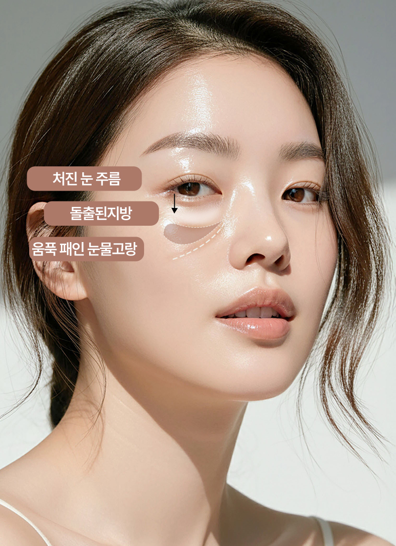 하안검