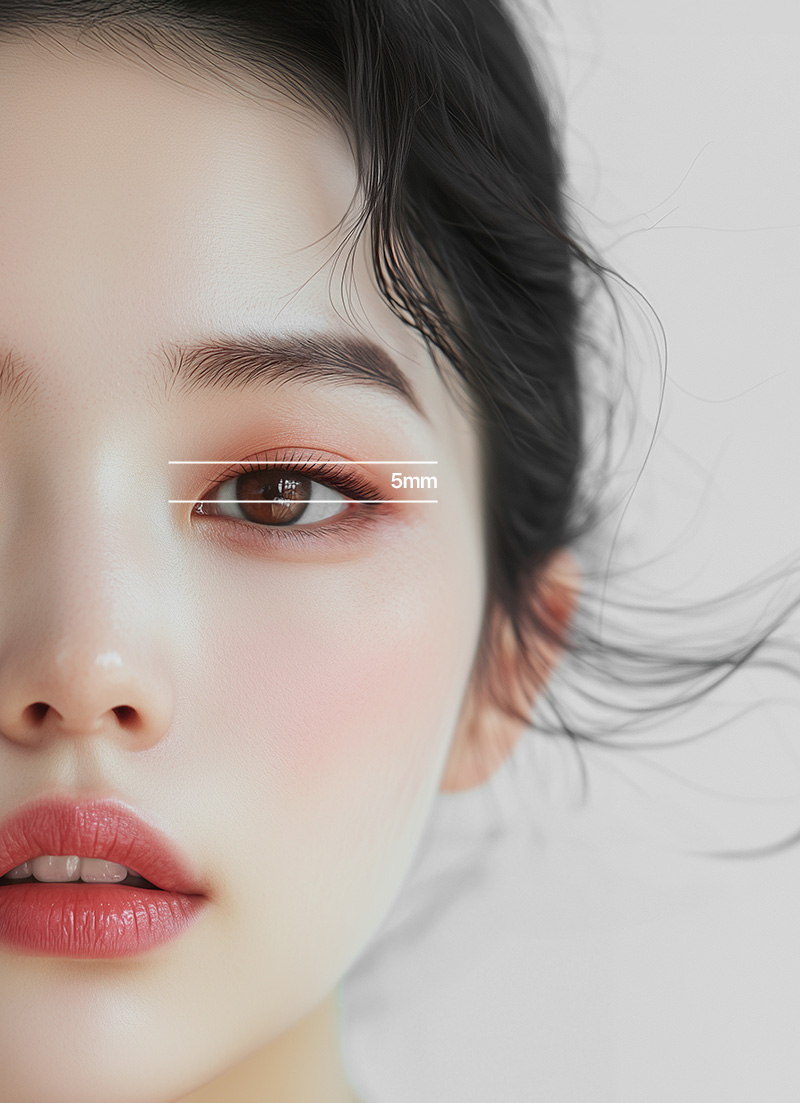 눈매교정