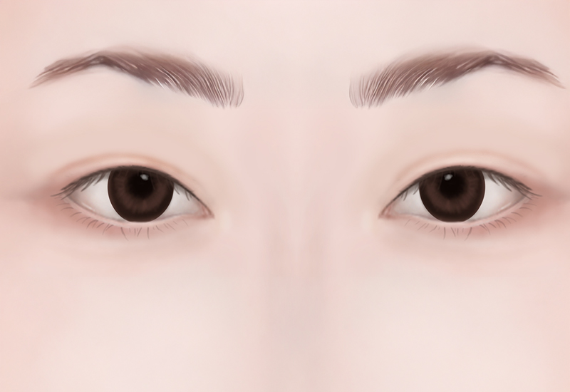 눈 재수술
