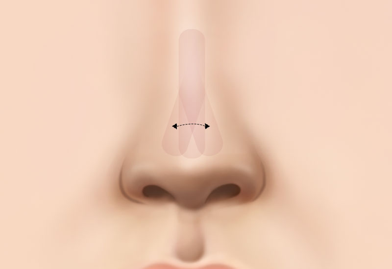 코 재수술