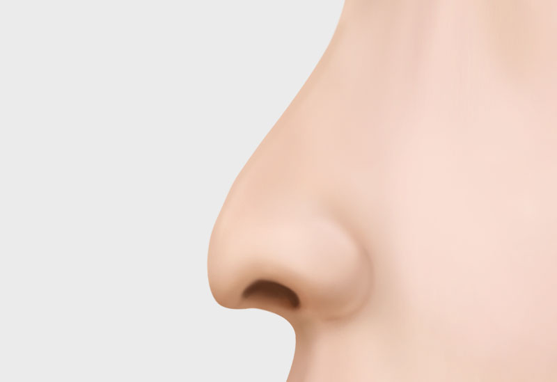 코 재수술