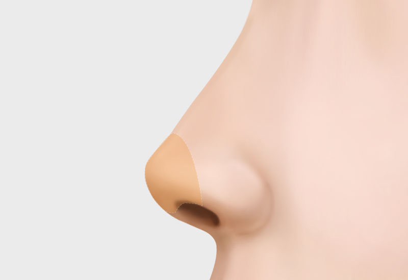 코 재수술