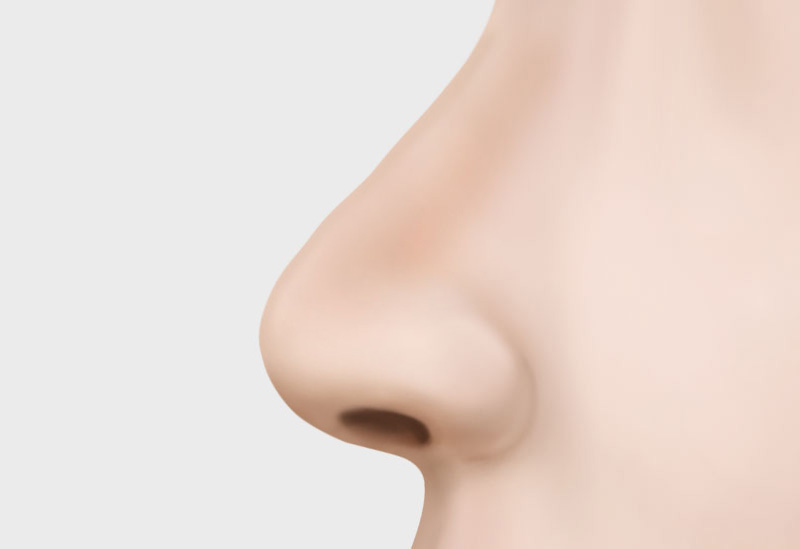 코 재수술