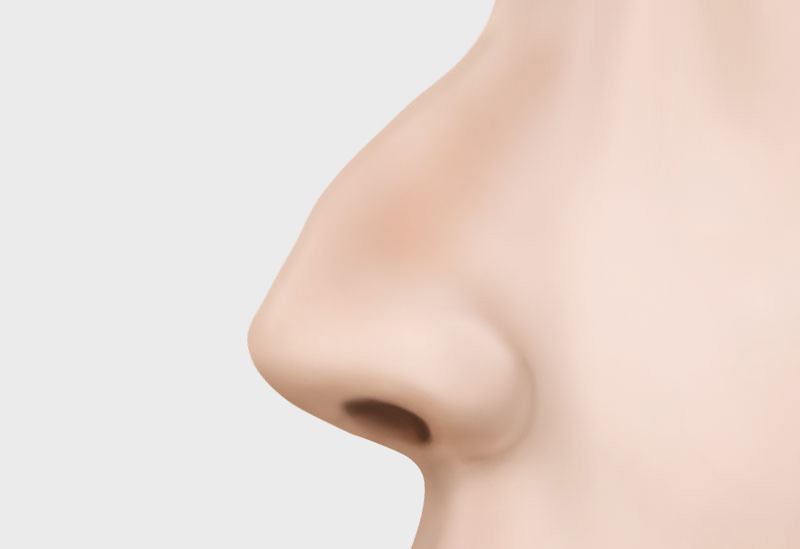 코 재수술