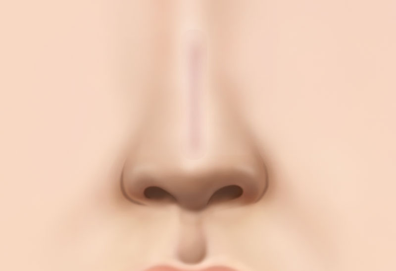 코 재수술