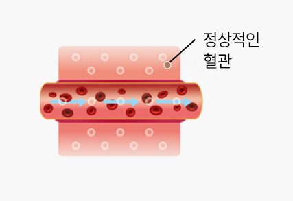 고압산소치료