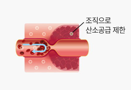 고압산소치료