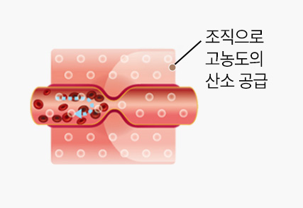 고압산소치료