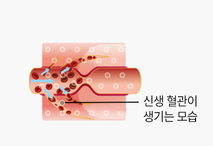 고압산소치료
