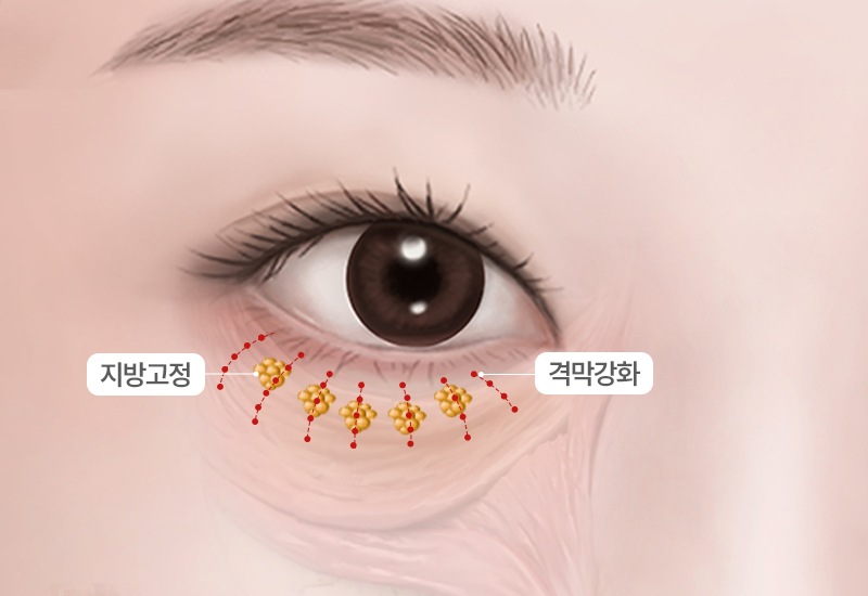 눈밑지방재배치
