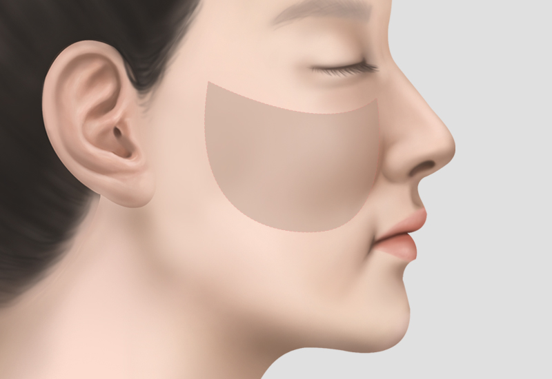 중안면부리프팅