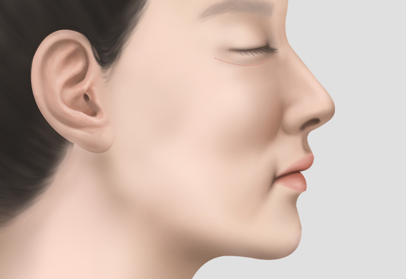 중안면부리프팅