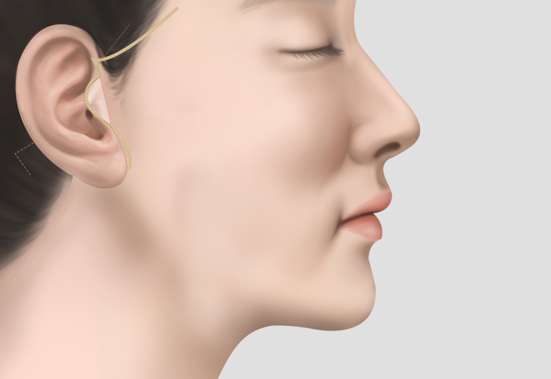 안면거상, 목거상