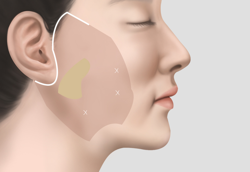 안면거상, 목거상