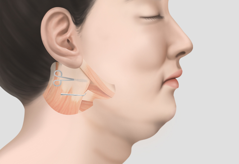 안면거상, 목거상