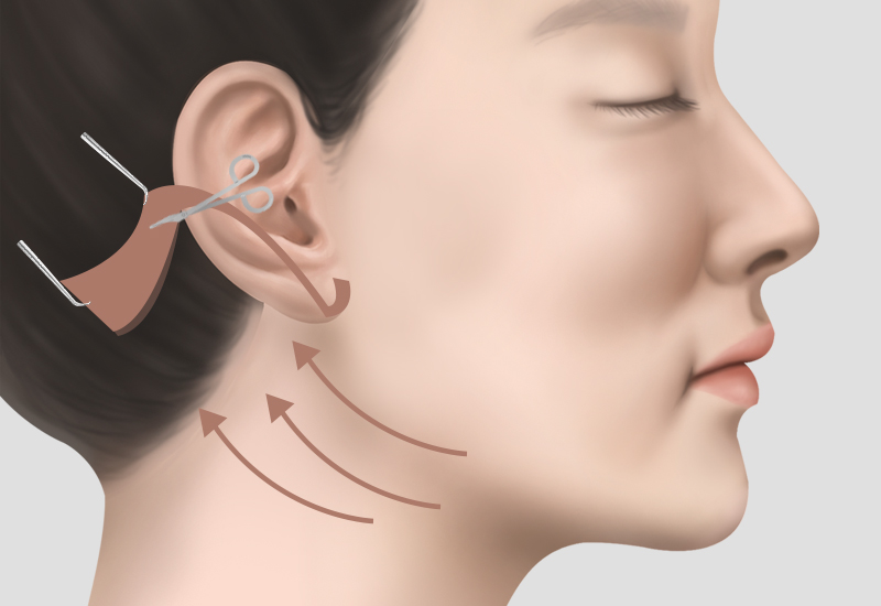 안면거상, 목거상