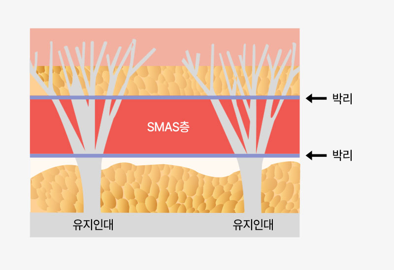 안면거상, 목거상